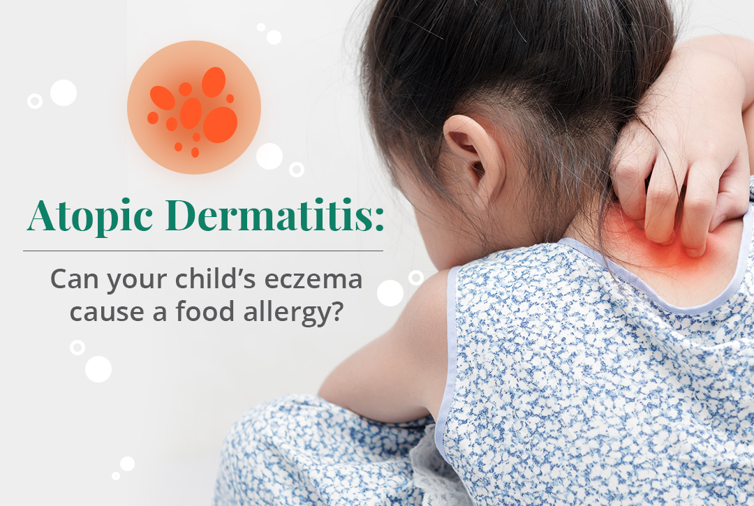 Atopic Dermatitis: Can your child’s eczema cause a food allergy? | See ...