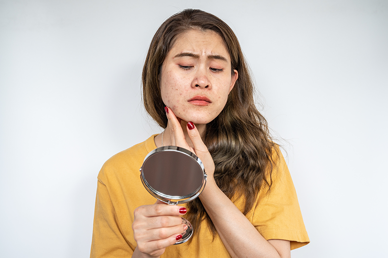 Acne poor gut health